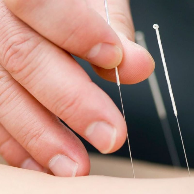 針灸
